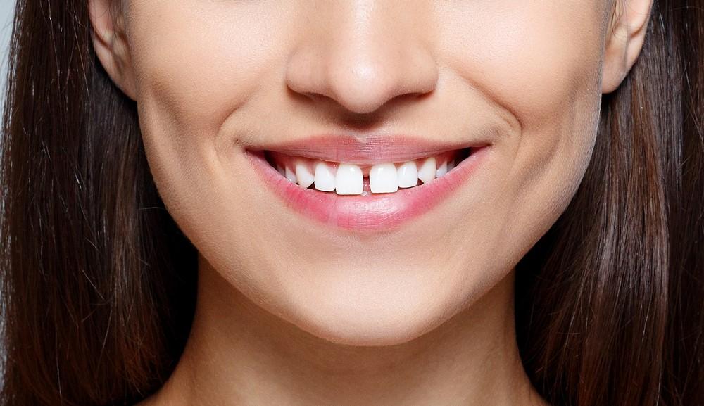 Diastema - a reason for pride and complexes