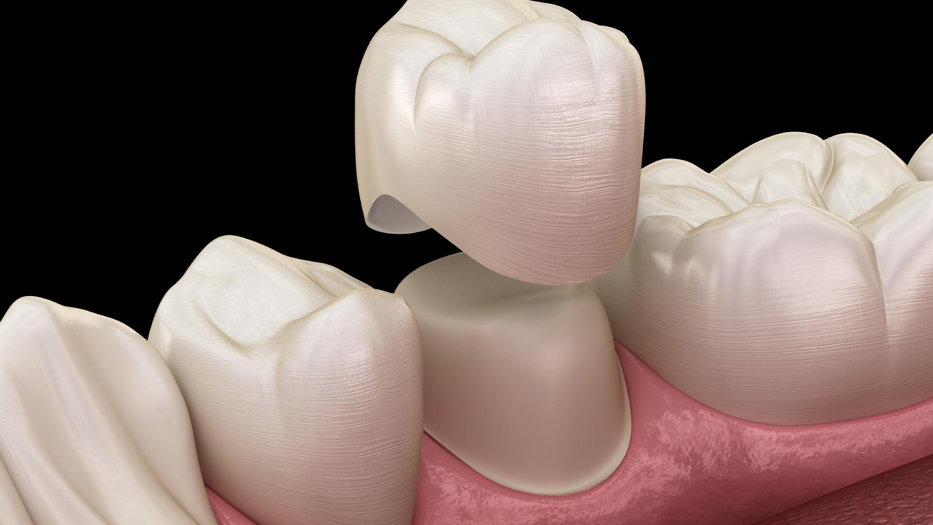 Dental crowns - innovative solutions in dentistry