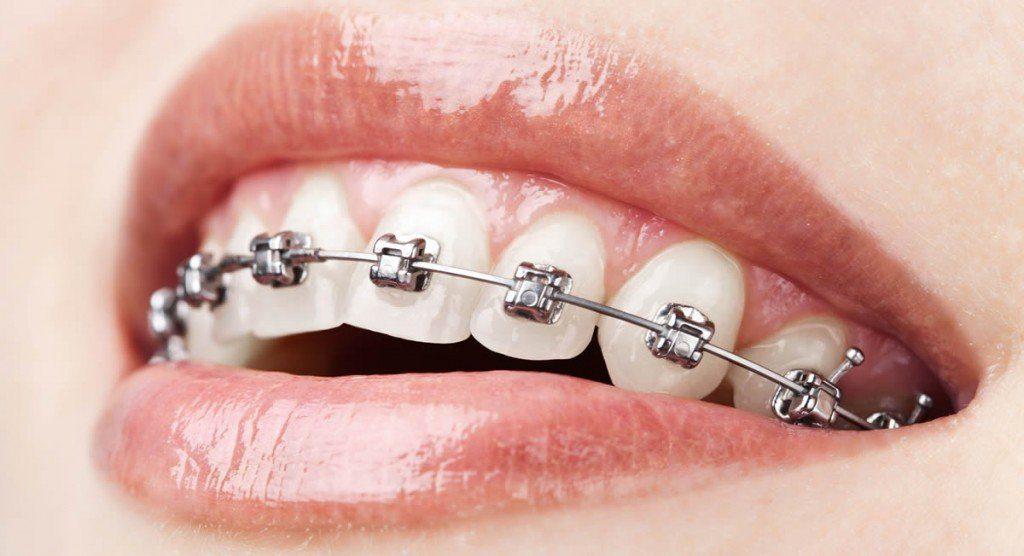 Higiena jamy ustnej z aparatem ortodontycznym