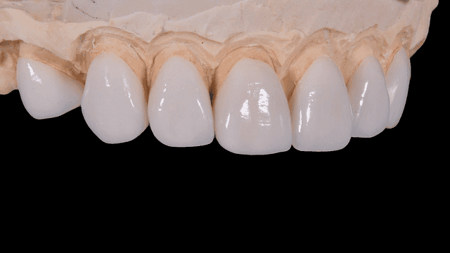 Veneers - are they worth it?