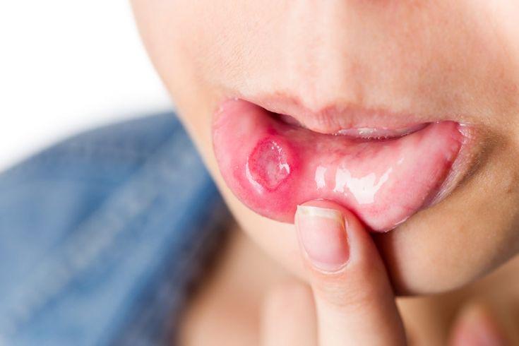 Canker Sores - Benign Lesions